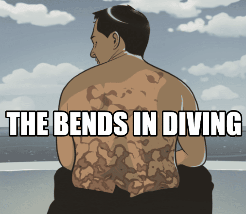 The bends in diving
